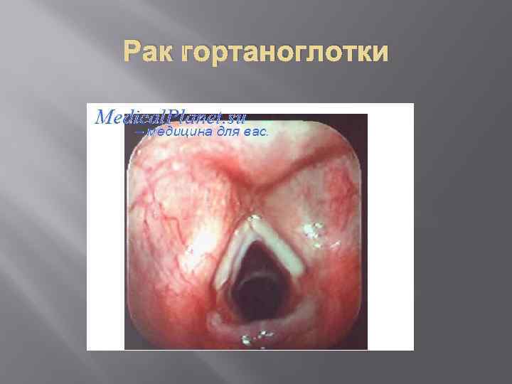 Рак гортаноглотки 