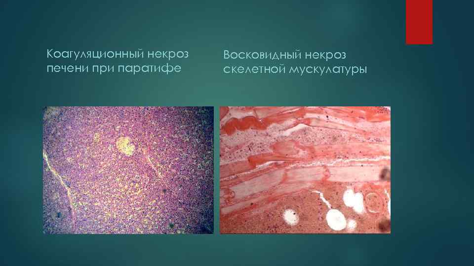 Коагуляционный некроз  Восковидный некроз печени при паратифе скелетной мускулатуры 