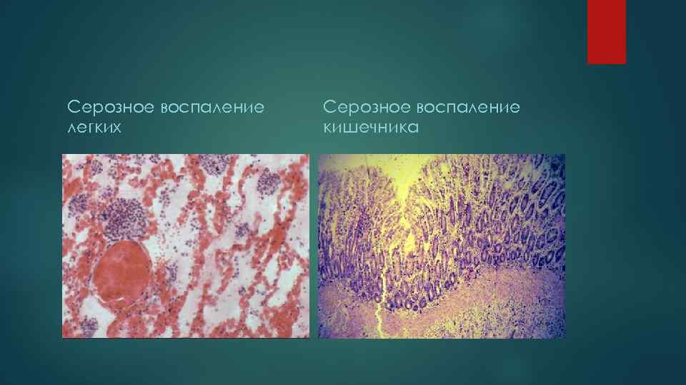 Картина воспаления. Серозный экссудат микропрепарат. Серозное воспаление патанатомия. Серозная пневмония микропрепарат. Серозное воспаление микропрепарат.