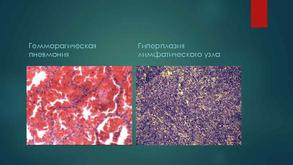 Гемморагическая  Гиперплазия пневмония   лимфатического узла 