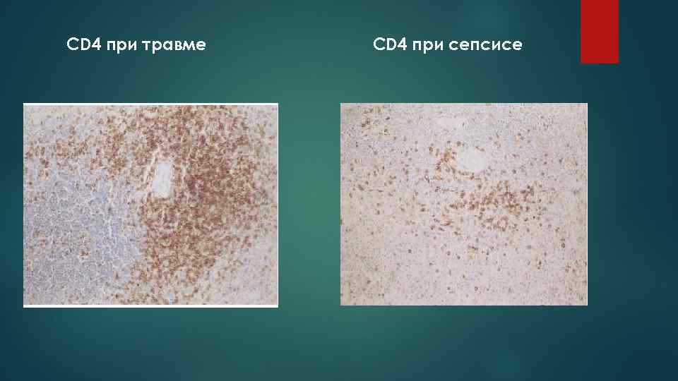 CD 4 при травме  CD 4 при сепсисе 