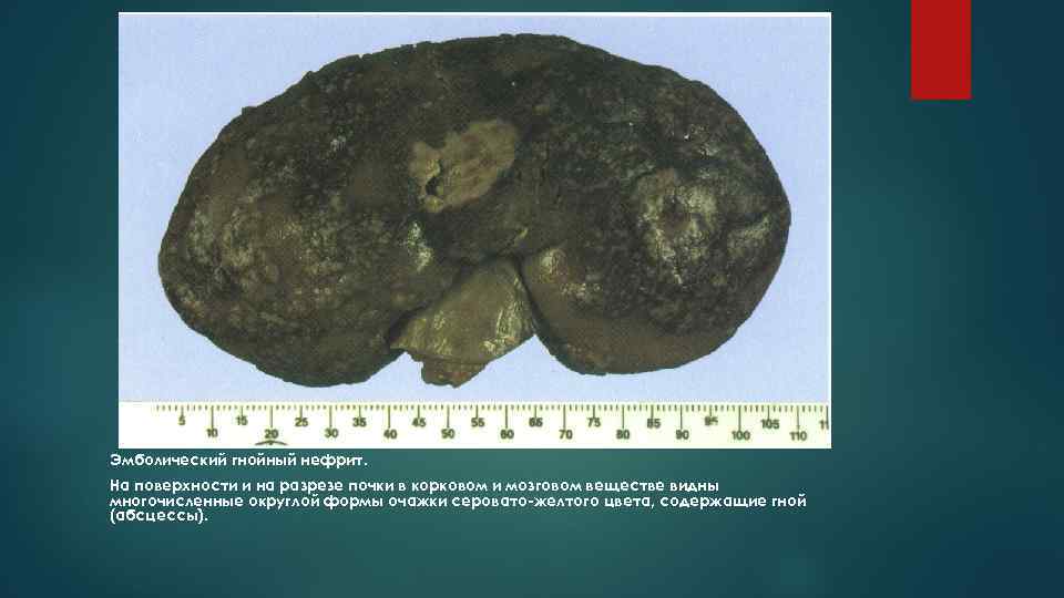 Эмболический гнойный нефрит. На поверхности и на разрезе почки в корковом и мозговом веществе