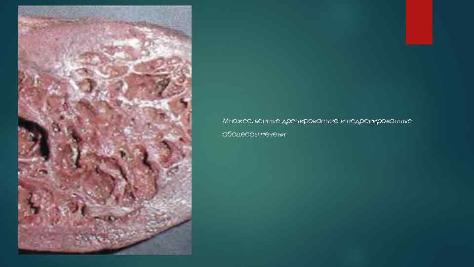 Множественные дренированные и недренированные абсцессы печени 