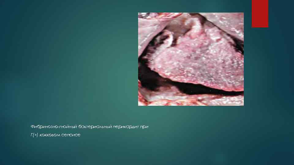 Фибринозно-гнойный бактериальный перикардит при Г(+) кокковом сепсисе 