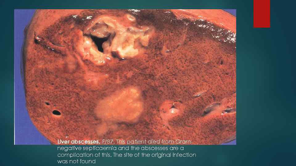 Liver abscesses. F/87. This patient died from Gram- negative septicaemia and the abscesses are