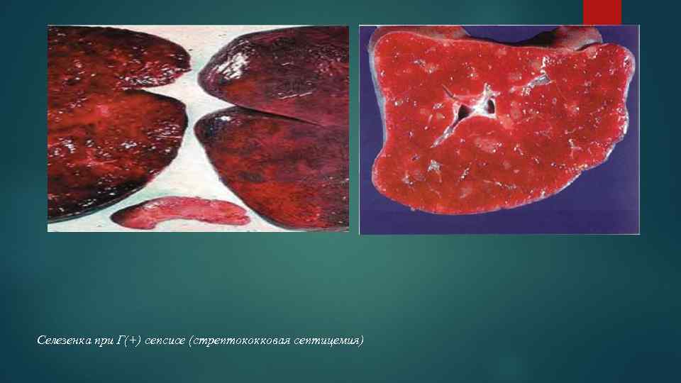 Селезенка при Г(+) сепсисе (стрептококковая септицемия) 