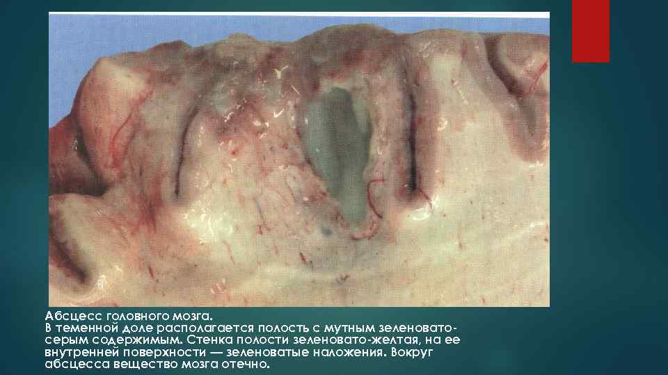 Абсцесс головного мозга. В теменной доле располагается полость с мутным зеленовато- серым содержимым. Стенка