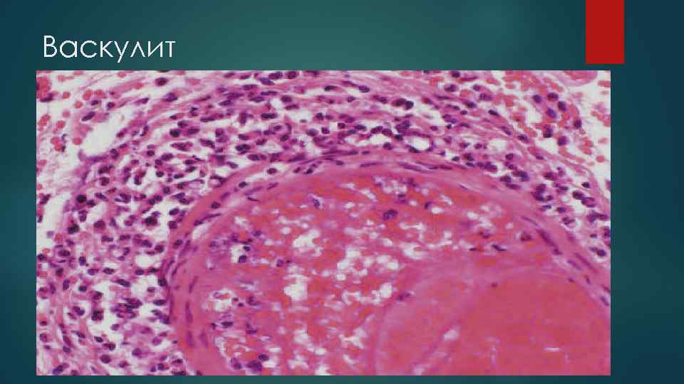 Васкулит 
