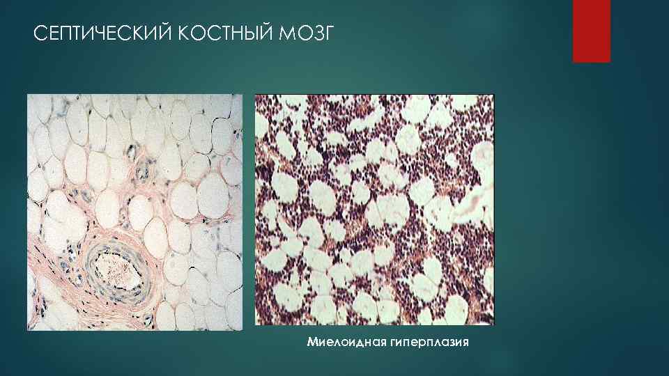 СЕПТИЧЕСКИЙ КОСТНЫЙ МОЗГ     Миелоидная гиперплазия 