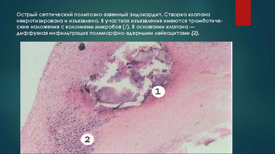 Острый септический полипозно-язвенный эндокардит. Створка клапана некротизирована и изъязвлена. В участках изъязвления имеются тромботиче-