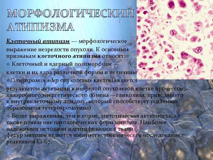 Цитологическая атипия. Атипизм ядер клетки опухоли. Полиморфизм опухолевых клеток. Полиморфизм ядер клеток. Полиморфизм и атипия клеток.