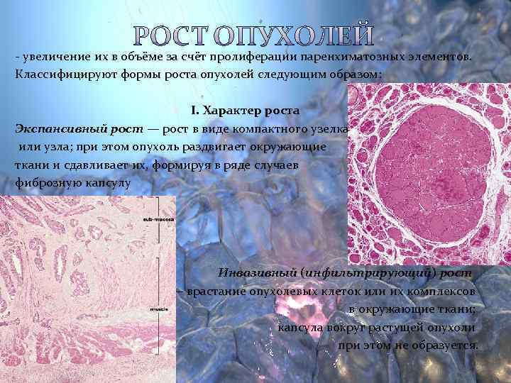 Экспансивный рост опухоли рисунок