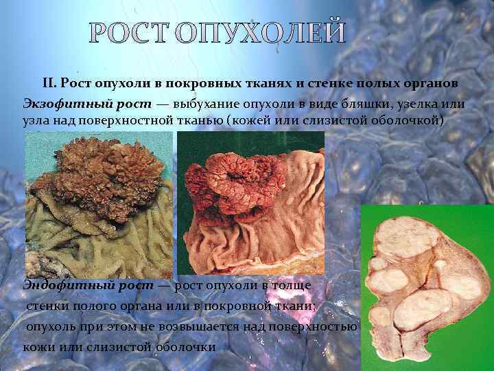   II. Рост опухоли в покровных тканях и стенке полых органов Экзофитный рост