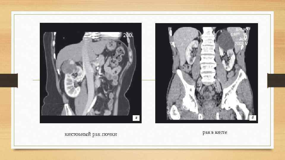 Рак почки выживаемость. Кистозная опухоль почки. Кистозная форма почечной карциномы. Диагноз т-г левой почки малигнизированная киста.