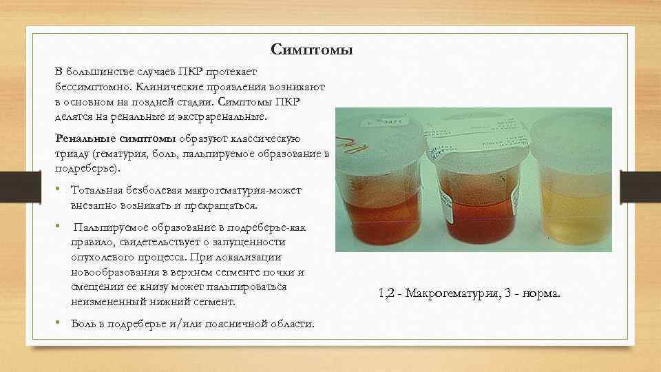     Симптомы В большинстве случаев ПКР протекает бессимптомно. Клинические проявления возникают