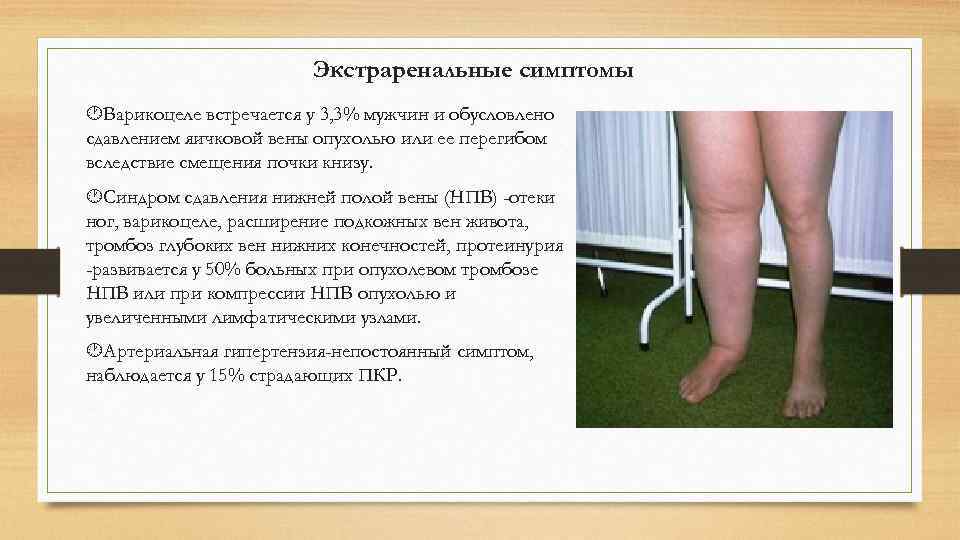     Экстраренальные симптомы Варикоцеле встречается у 3, 3% мужчин и обусловлено