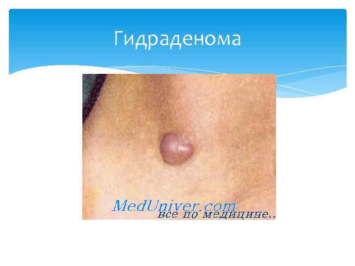 Гидраденома 