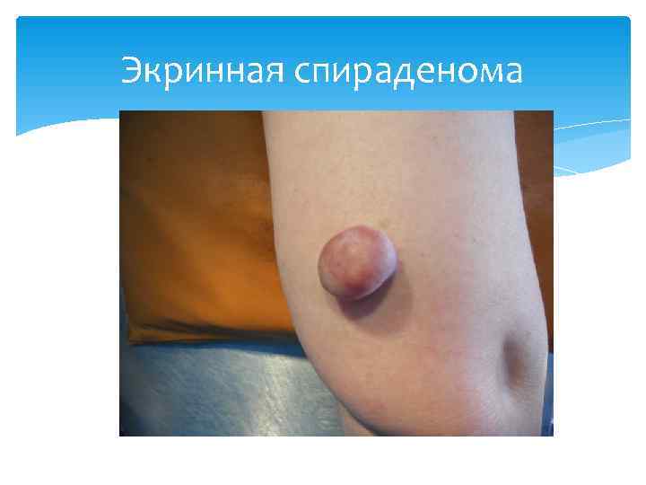 Экринная спираденома 