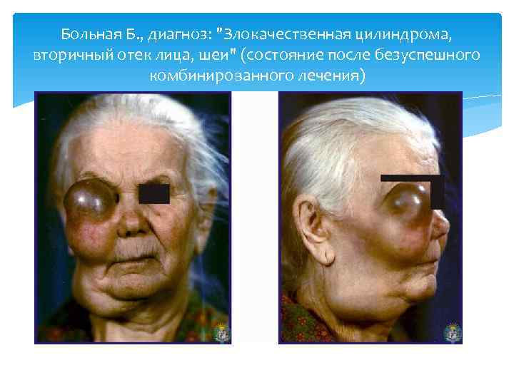   Больная Б. , диагноз: 