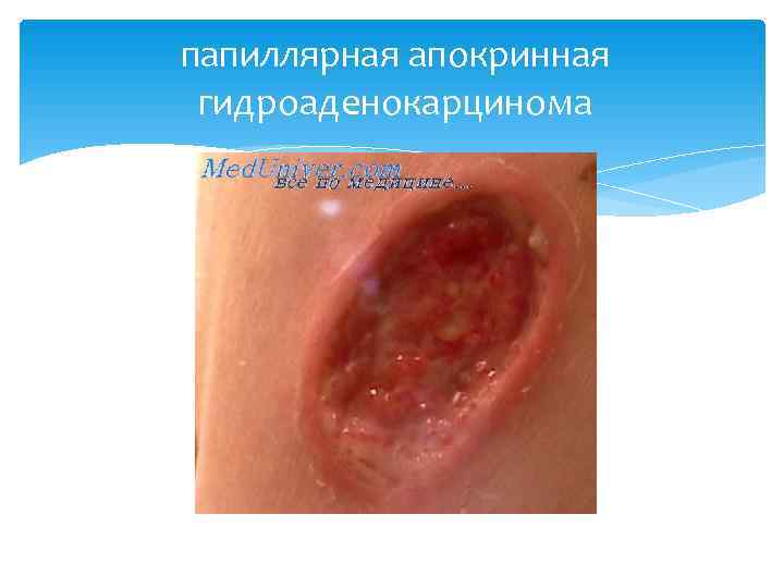 папиллярная апокринная гидроаденокарцинома 