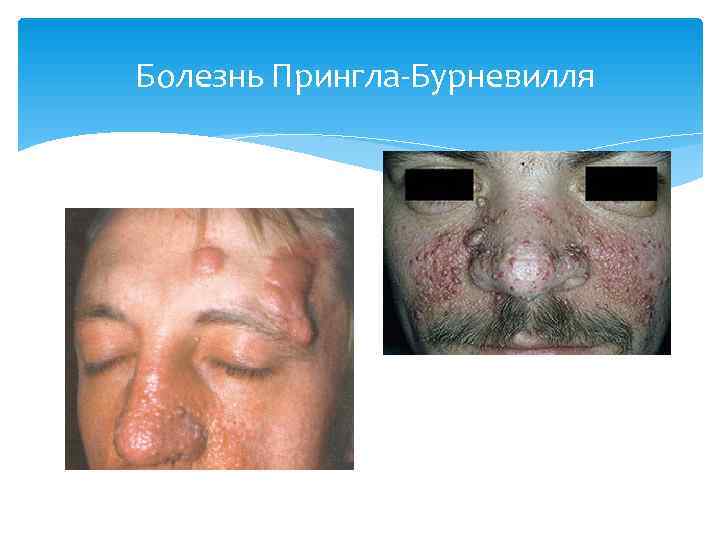 Болезнь Прингла-Бурневилля 