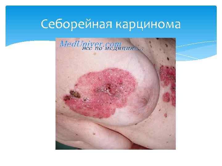 Себорейная карцинома 