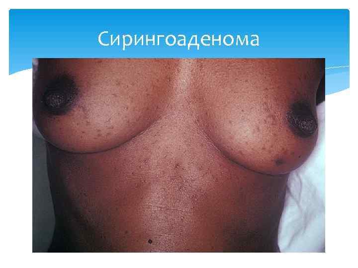 Сирингоаденома 