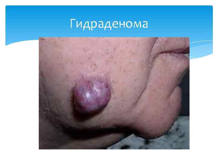 Гидраденома 