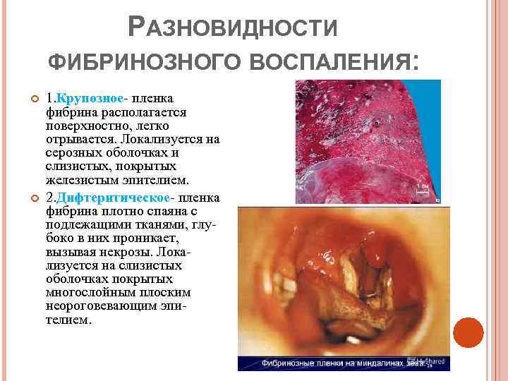     РАЗНОВИДНОСТИ ФИБРИНОЗНОГО ВОСПАЛЕНИЯ: 1. Крупозное- пленка фибрина располагается поверхностно, легко
