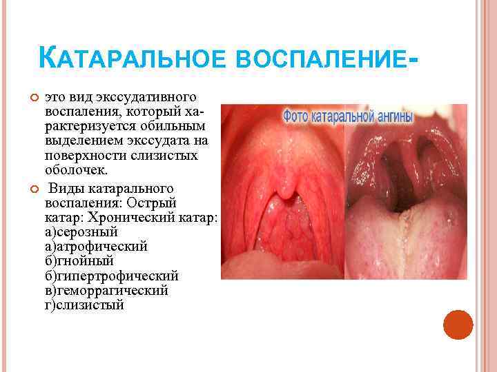 КАТАРАЛЬНОЕ ВОСПАЛЕНИЕ- это вид экссудативного воспаления, который ха- рактеризуется обильным выделением экссудата на поверхности
