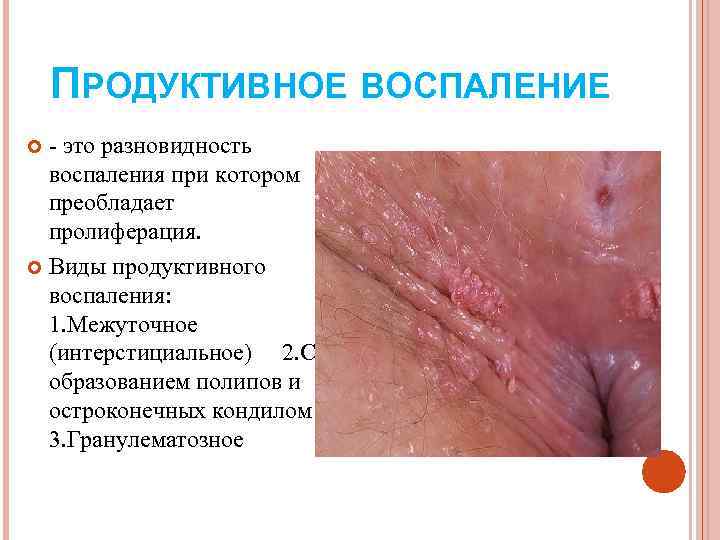   ПРОДУКТИВНОЕ ВОСПАЛЕНИЕ  - это разновидность  воспаления при котором  преобладает