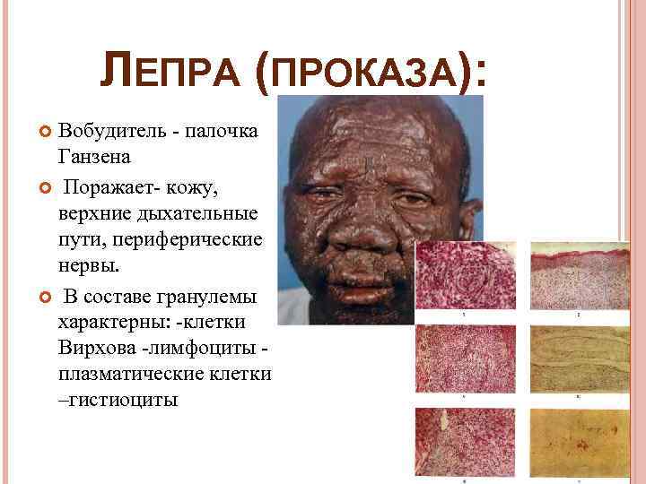  ЛЕПРА (ПРОКАЗА):  Вобудитель - палочка  Ганзена  Поражает- кожу, верхние дыхательные