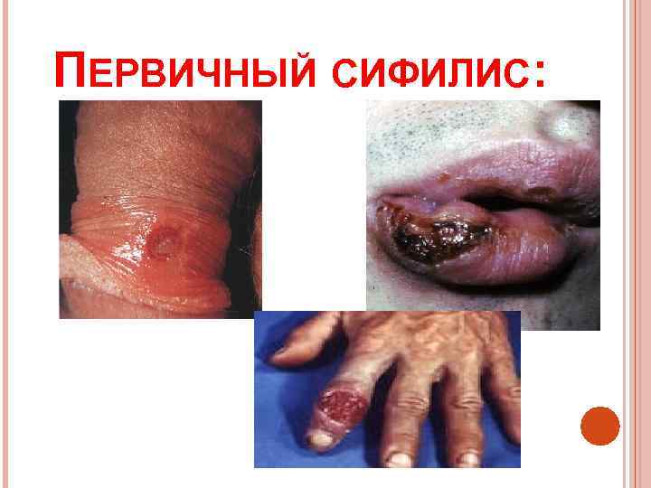 ПЕРВИЧНЫЙ СИФИЛИС: 