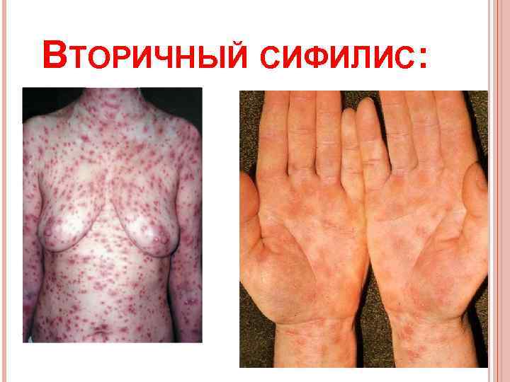 ВТОРИЧНЫЙ СИФИЛИС: 