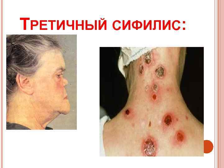 ТРЕТИЧНЫЙ СИФИЛИС: 