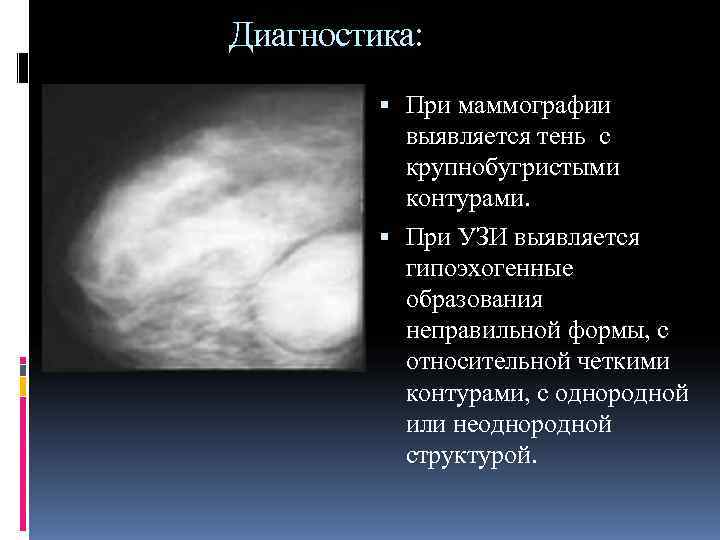 Образование в молочной железе. Саркома молочной железы на маммографии. Гипоэхогенные образования молочных желез. Образования в молочной железе на маммографии. Образование в молочной железе с четкими контурами на маммографии.