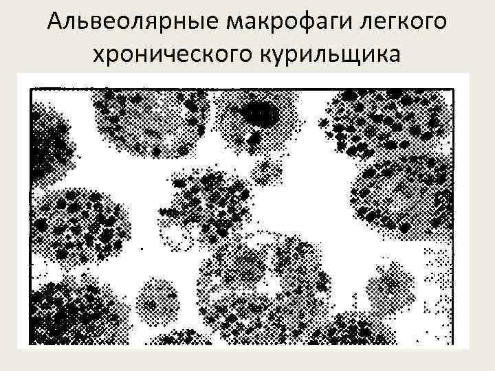 Альвеолярные макрофаги легкого хронического курильщика 