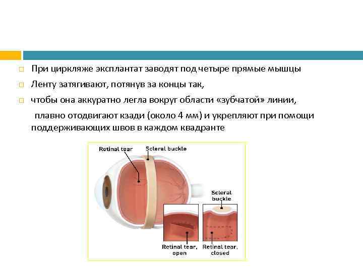  При циркляже эксплантат заводят под четыре прямые мышцы Ленту затягивают, потянув за концы