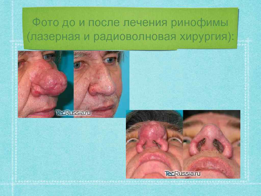 Фото до и после лечения ринофимы (лазерная и радиоволновая хирургия): 