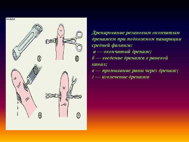 Дренирование резиновым окончатым дренажем при подкожном панариции средней фаланги: а — окончатый дренаж; б