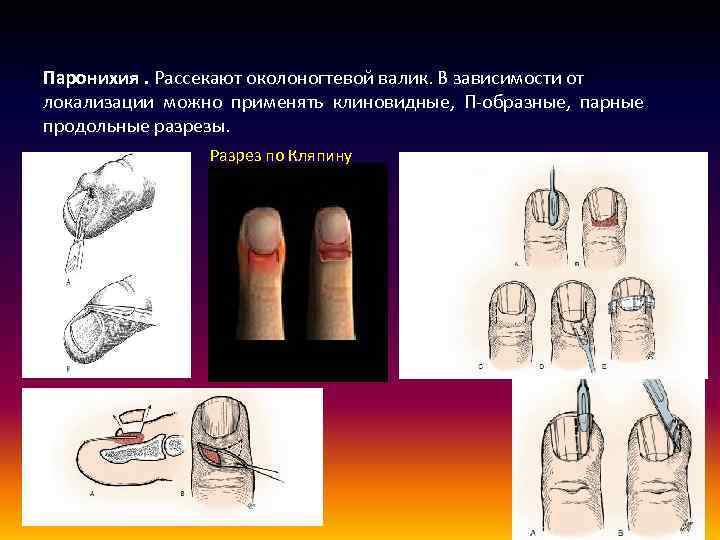 Паронихия. Рассекают околоногтевой валик. В зависимости от локализации можно применять клиновидные, П-образные, парные продольные