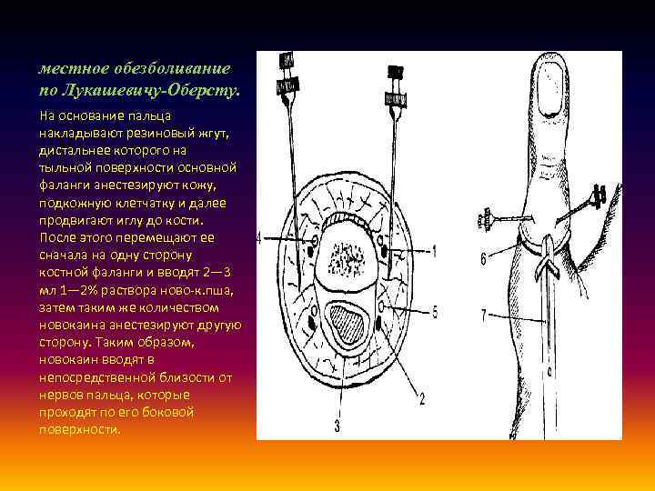 местное обезболивание по Лукашевичу-Оберсту. На основание пальца накладывают резиновый жгут, дистальнее которого на тыльной