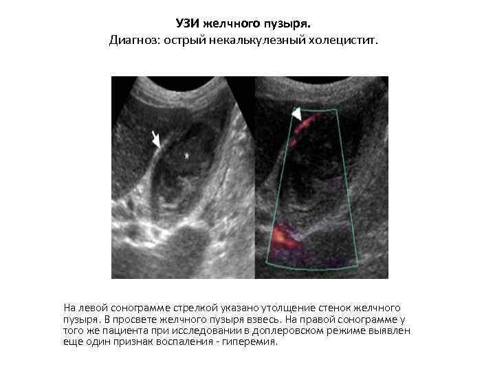 УЗИ желчного пузыря. Диагноз: острый некалькулезный холецистит. На левой сонограмме стрелкой указано утолщение стенок