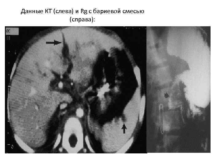 Данные КТ (слева) и Rg c бариевой смесью (справа): 