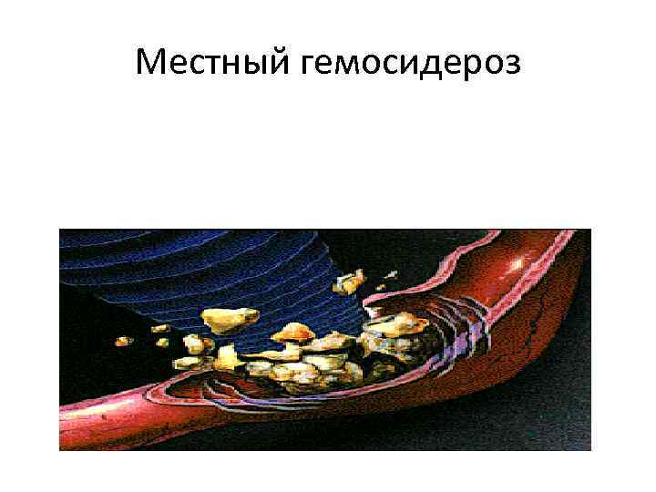 Местный гемосидероз 