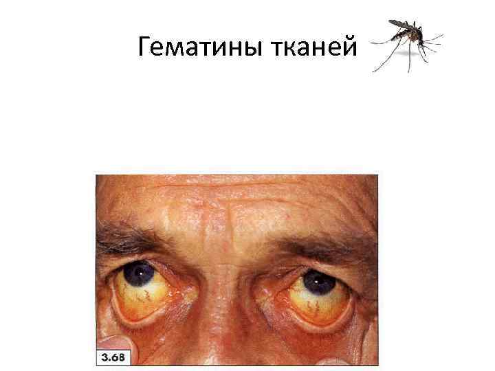 Гематины тканей 