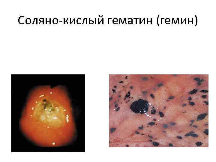 Соляно-кислый гематин (гемин) 