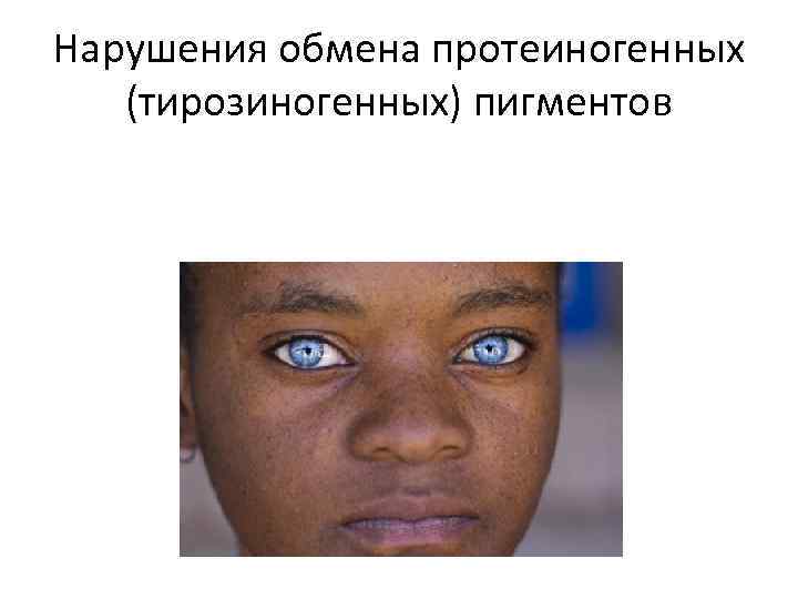 Нарушения обмена протеиногенных (тирозиногенных) пигментов 