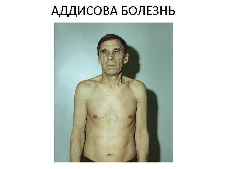 АДДИСОВА БОЛЕЗНЬ 