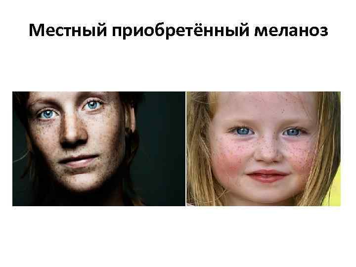 Местный приобретённый меланоз 